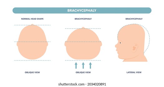 craniosynostosis helmet pillow flat head autism brain skull bone deformity baby infant child newborn defect birth anterior Metopic Born genes genetic position sleep shape deformation tummy time svg