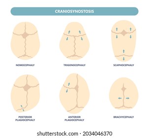 Schädelknochen von Craniosynostosis