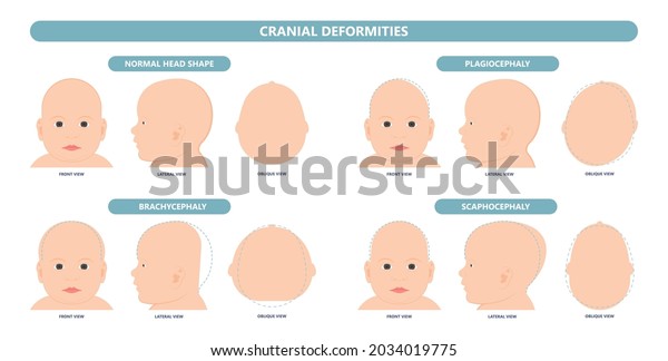 craniosynostosis helmet pillow flat head autism\
brain skull bone deformity baby infant child newborn defect birth\
anterior Metopic Born genes genetic position sleep shape\
deformation tummy\
time