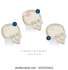 Craniotomy Surgery Bone Flap Removal Stock Stock Vector (Royalty Free ...