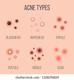 Creative vector illustration types of acne, pimples, skin pores, blackhead, whitehead, scar, comedone, stages diagram isolated on transparent background. Art design . Abstract concept graphic element