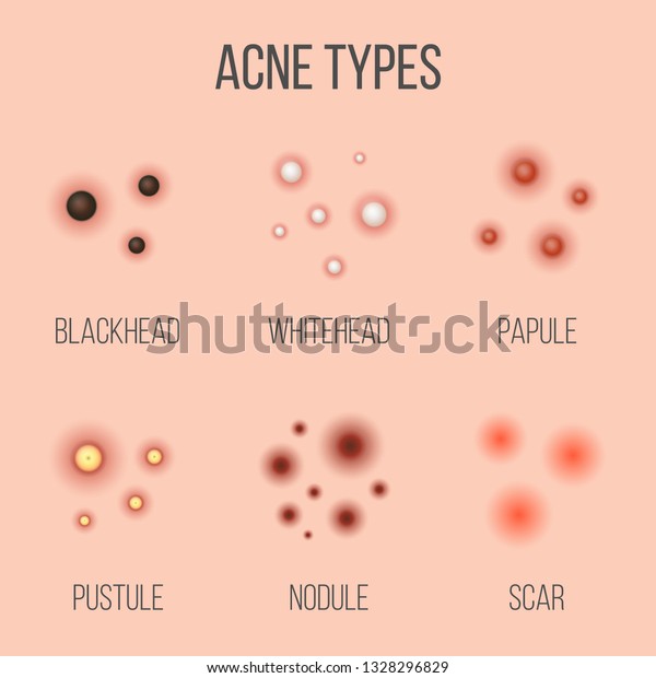 Creative Vector Illustration Types Acne Pimples Stock Vector (Royalty ...