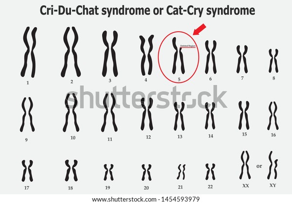 Syndrom chat cri du Cri Du