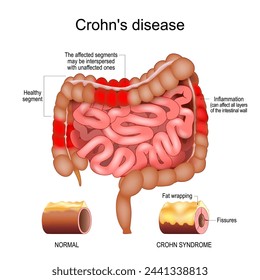 Crohn disease. Human large and small intestine with Healthy segments and Inflammation that affect  layers of the intestinal wall. Close-up of a cross section of a intestinal wall with Fat wrapping