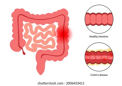 Crohns disease concept. Inflamed and healthy intestine. Inflammatory bowel disease. Inflammation of the digestive tract, abdominal pain in the colon. Anatomical medical poster flat vector illustration