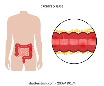Crohns disease concept. Inflammatory bowel disease. Inflammation of the digestive tract, abdominal pain and colon problem in human body. Intestine anatomical medical poster flat vector illustration.