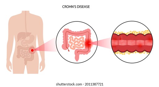Crohns disease concept. Inflammatory bowel disease. Inflammation of the digestive tract, abdominal pain and colon problem in human body. Intestine anatomical medical poster flat vector illustration.