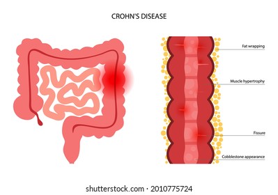 Crohns disease concept. Intestine anatomical infographic. Inflammatory bowel disease. Inflammation of the digestive tract, abdominal pain, colon problem in human body. Medical flat vector illustration