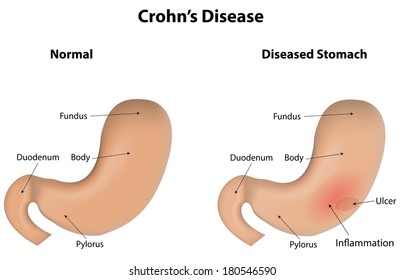 Crohn's Disease IBD