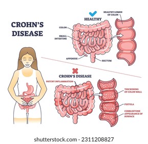 Enfermedad de Crohns como diagrama de esquema de explicación del problema intestinal inflamatorio. Comparación médica educativa marcada con enfermedad estomacal y colon sano, intestino delgado e ilustración del vector intestinal.