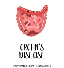 Crohn's disease. Intestines diseases. Gastroenterology. Vector flat illustration. Perfect for flyer, medical brochure, banner, landing page, website