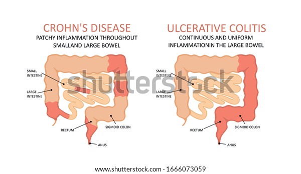 Crohns Disease Ulcerative Colitis Stock Vector (Royalty Free) 1666073059