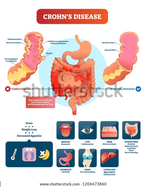 Crohns Disease Vector Illustration Labeled Diagram Stock Vector ...