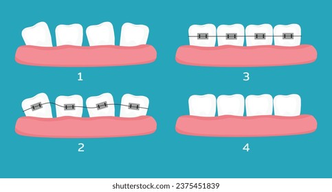 Crooked teeth alignment with dental braces treatment stages