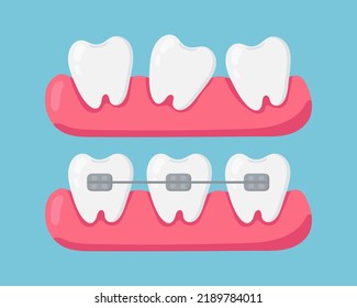 Crooked Teeth And Teeth With Braces. Vector Illustration