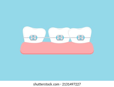 Crooked teeth with dental braces in gym. Dental braces on misaligned white tooth with gap orthodontic bracket correction treatment concept. Vector flat design dentistry illustration.