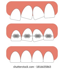 Crooked teeth, with dental braces, straight teeth after correcting with braces. Vector illustration of stages using dental braces. Poster for dentist, orthodontist. Result after using bracket system.