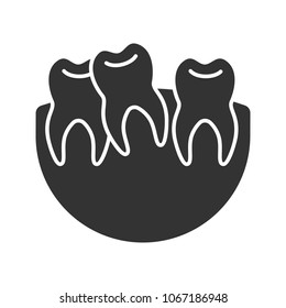 Crooked teeth glyph icon. Malocclusion. Wisdom tooth problem. Silhouette symbol. Negative space. Vector isolated illustration