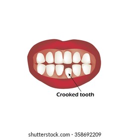 Crooked teeth. Orthodontics. Infographics. Vector illustration on isolated background.