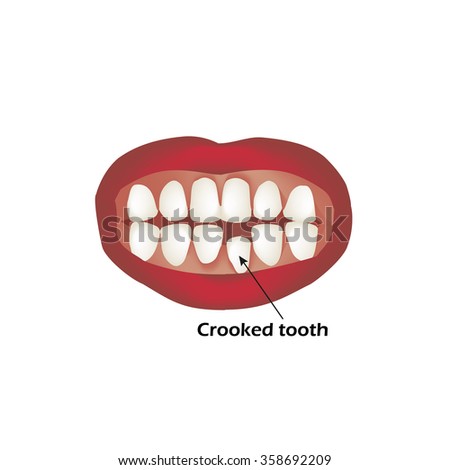 Crooked teeth. Orthodontics. Infographics. Vector illustration on isolated background.