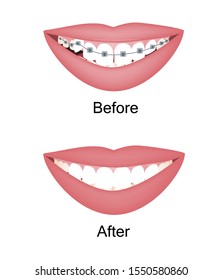 Crooked Woman Teeth Before And After The Orthodontic Treatment With Braces. Vector Illustration Isolated Set.