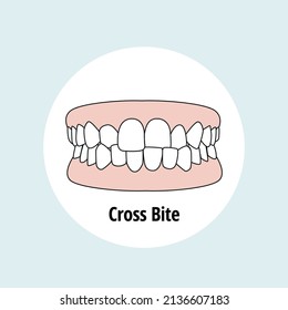 
Cross Bite. Dental problem vector illustration. Dental care concept.