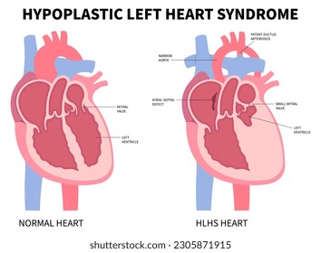 Cross section anatomy of heart with left ventricle hypertrophy the concept in medical