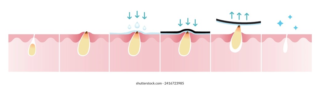 Cross section of blackhead acne and how to remove pimple vector isolated on white background. Wet the skin, apply, peel off, unclogging and tighten pore. Skin care and beauty concept illustration.