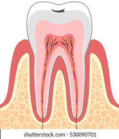 Cross section of caries