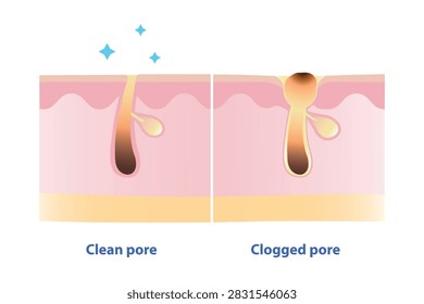 Cross section of clean and clogged pore on skin layer vector illustration. Comparison of open pores stay clean, skin looks smooth and fresh. When they clog, face acne, blackheads, and rough texture.