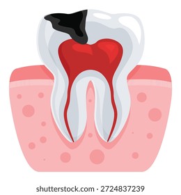 Sección transversal de un diente en descomposición con inflamación de la pulpa y las encías, ilustrando problemas dentales
