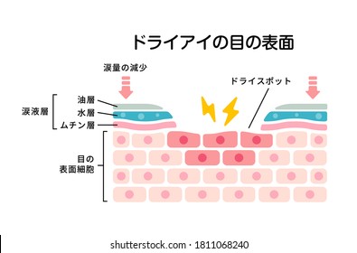 Cross Section Of Dry Eye Surface. Flat Vector Illustration. Translation: Dry Eye, Tear Film, Lipid Layer, Aqueous Layer, Mucin Layer, Cornea, Tears Decreased, Dry Spot.