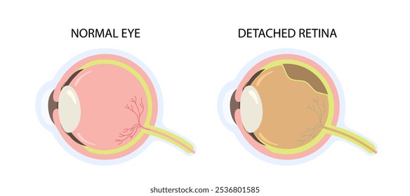 Seção transversal do olho com descolamento da retina e condição normal. Retina descasca em diagrama esquemático