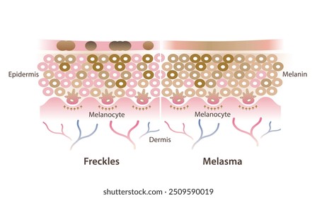 Seção transversal de sardas e melasma na ilustração do vetor da camada da pele isolada no fundo branco. A comparação das sardas são pequenas manchas planas marrons e o melasma é marrom, manchas azuis cinzentas na pele.