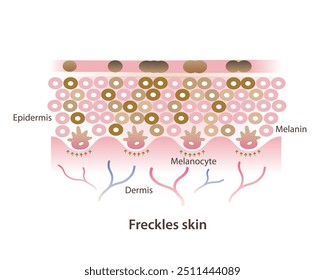 Cross section of freckles on skin layer vector illustration isolated on white background. Freckles are small flat brown spots on skin, types of hyperpigmentation, ephelides, solar lentigines.