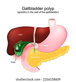 Cross section of a Gallbladder with polyps. Abnormal accumulations of mucous membrane tissue. Part of a human gastrointestinal tract with liver, duodenum, pancreas and stomach. Vector poster