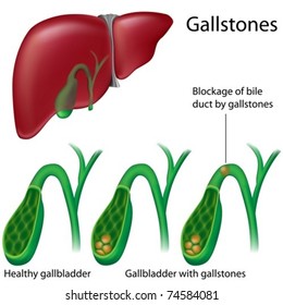 Cross section of gallbladder with and without gallstones