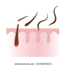 The cross section of hair losing with scalp layer vector illustration isolated on white background. Weak, brittle, fall hair to alopecia, baldness and hair loss. Hair anatomy and problem concept.