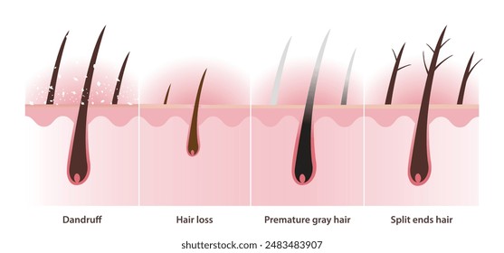 La sección transversal de los problemas del pelo con la Ilustración vectorial de la capa del cuero cabelludo sobre fondo blanco. Caspa, cuero cabelludo escamoso seco blanco, pérdida de cabello, alopecia, pelo gris prematuro y pelo de puntas abiertas.