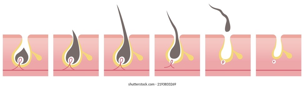 Cross section of hair removal steps. Vector illustration isolated on white background.