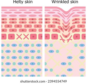 Cross section of healthy skin and wrinkled skin