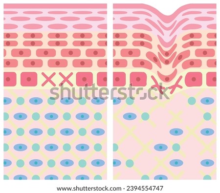 Cross section of healthy skin and wrinkled skin