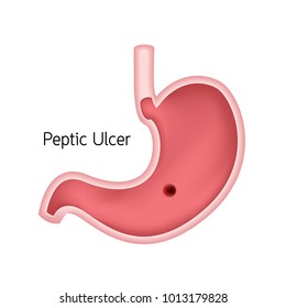 Cross section of human stomach. Peptic ulcer, human heath care. Vector illustration isolated on white background