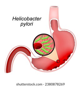 Cross section of a human Stomach with ulcers. Close-up of bacteria Helicobacter pylori that caused Gastric ulcers. Peptic ulcers. Vector illustration