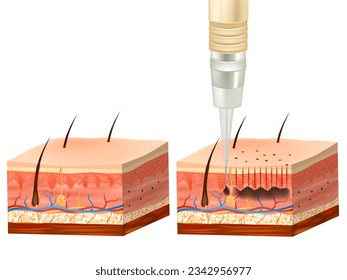 Cross section of layers of a human skin of Process of tattooing. Procedure of permanent makeup. Pigment under skin of Epidermis and  Dermis.