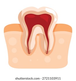 Seção transversal do dente molar mostrando pulpite com polpa inflamada e canais radiculares