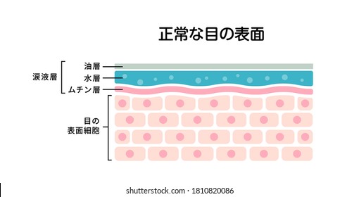 Cross Section Of Normal Eye Surface. Flat Vector Illustration.  Translation: Normal Eye, Tear Film, Lipid Layer, Aqueous Layer, Mucin Layer, Cornea, Tears Decreased, Dry Spot.