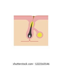 Cross section of pores ( acne progression) / Clogged pore