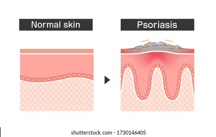 Cross section of psoriasis and normal skin / flat vector illustration