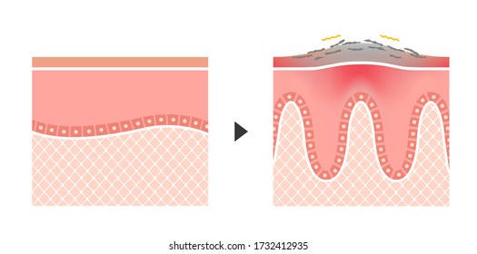 Cross Section Of Psoriasis And Normal Skin / Flat Vector Illustration